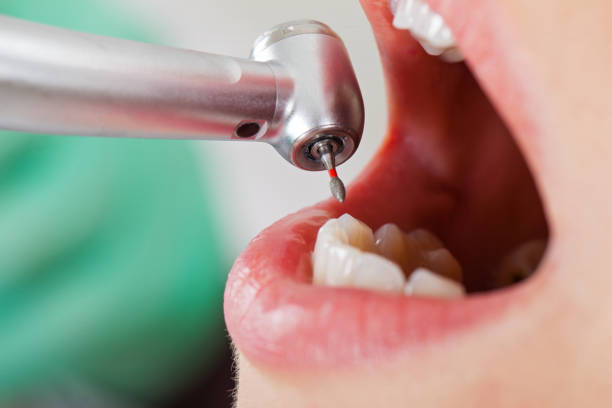 Best Emergency Dental Care for Sports Injuries in Greenville, SC